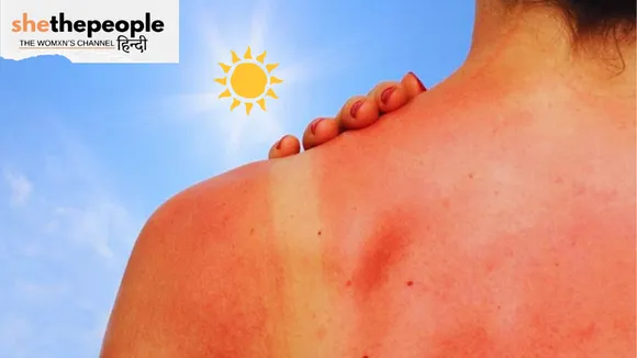 sun burn.png