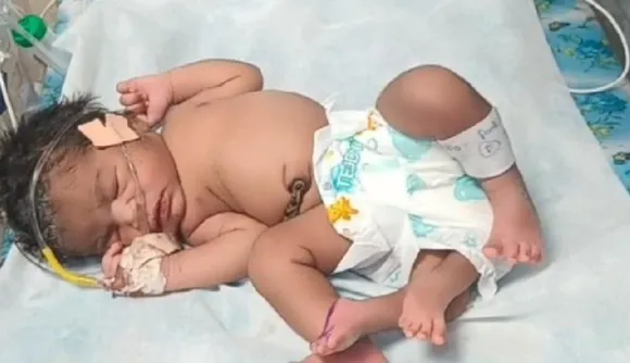 baby born with four legs