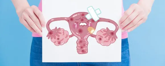 PCOS img 22.png