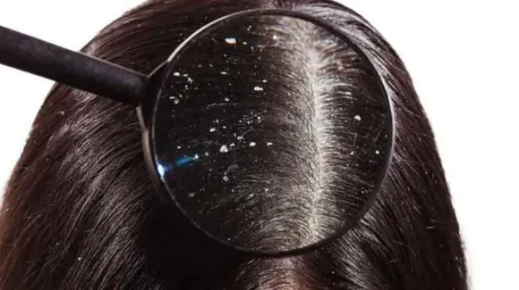 dandruff 
