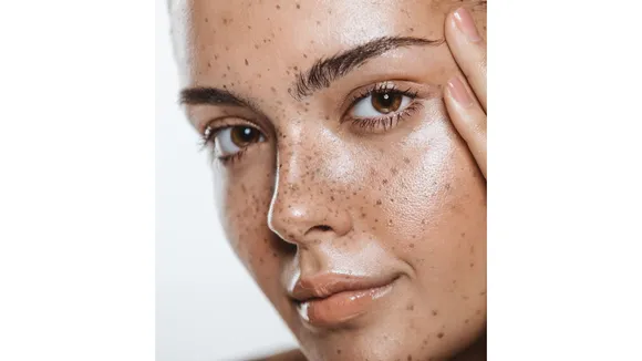 Face pigmentation (Face by SM).png