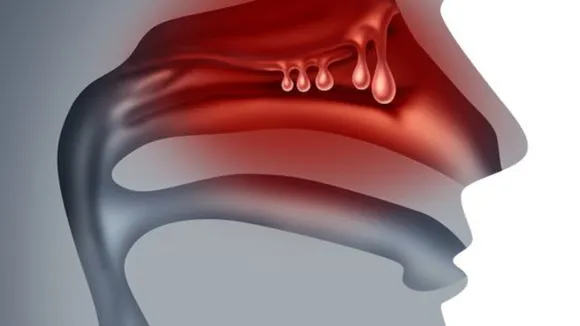 Nasal Congestion (PInterest).png