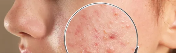 Acne 0000. png
