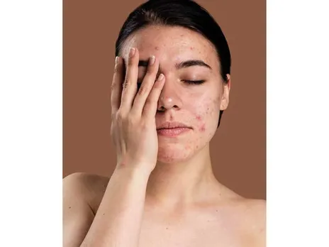  मुहांसे 