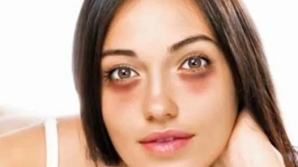 Dark Circles (Pinterest).png