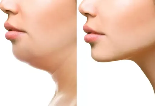 Double Chin से हैं परेशान? जाने इससे छुटकारा पाने के 6 तरीकें
