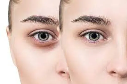 Reasons For Dark Circles : डार्क सर्कल होने की 5 वजह