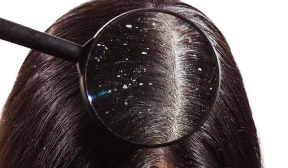 Remedies For Dandruff: डैंड्रफ को दूर रखने के 5 नेचुरल उपाय
