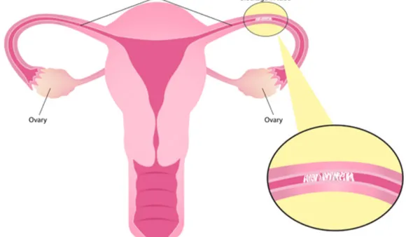 Remedies For Blocked Fallopian Tubes: बंद फैलोपियन ट्यूब के लिए नेचुरल रेमेडीज