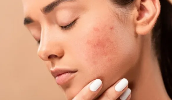 Dark Spot Prevention & Remedies: कैसे करें डार्क स्पॉट्स का इलाज?