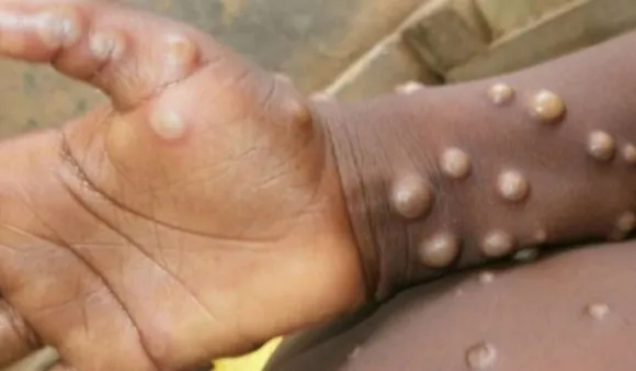 Monkeypox क्या है? जानिए इस नयी बीमारी से जुड़ी जरुरी बातें 