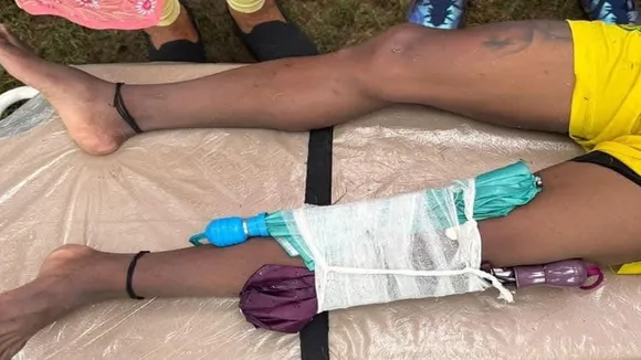 Tarak Hembram Injury: জোড়া ছাতা দিয়ে বাংলার ফুটবলার তারক হেমব্রমের চোটগ্রস্ত পায়ে সাপোর্ট