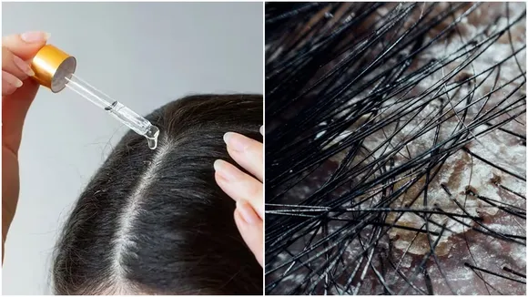 Natural Dandruff Cure: জেনে নিন প্রাকৃতিক উপায়ে খুশকি দূর করার কায়দা।