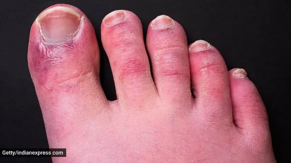 Covid toes, Covid-19, Corona Virus, কোভিড-টো, করোনা ভাইরাস