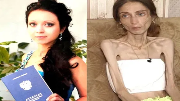 Woman starves herself to 22kg, Woman starves herself for husband, plump cheeks, dieting karke kankal bani mahila, Woman starves herself to 22kg for husband, crash dieting, woman became skeleton, woman looses weight drastically, weight loss, how to loose weight on healthy way, odd news, strange news, weird news, viral on internet, ajab gajab, offbeat news, ajeebogarib, khabar hatke, zara hatke news, bizarre news, trending news