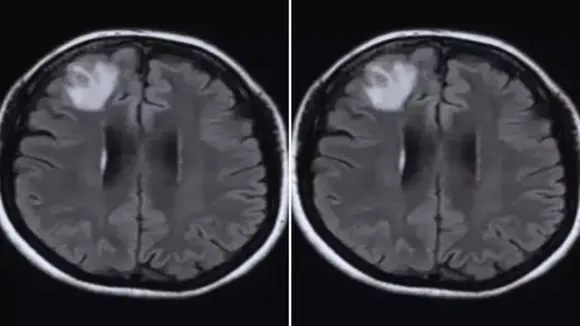 worm living in woman brain first case discovered by doctors