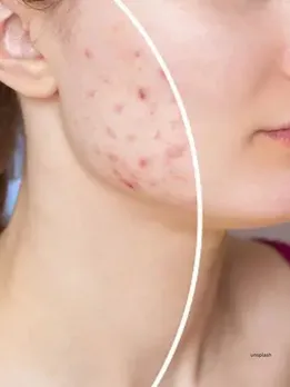 Skincare Tips : These tips will be helpful in removing blemishes from the face (unsplash)