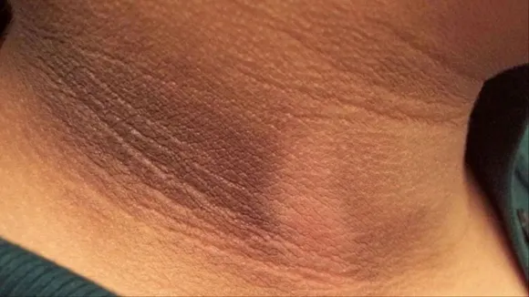 dark neck home remedies