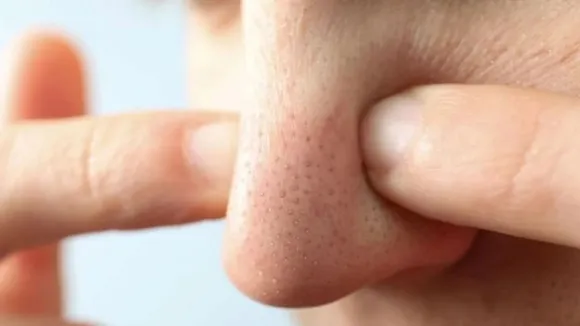 nose blackheads