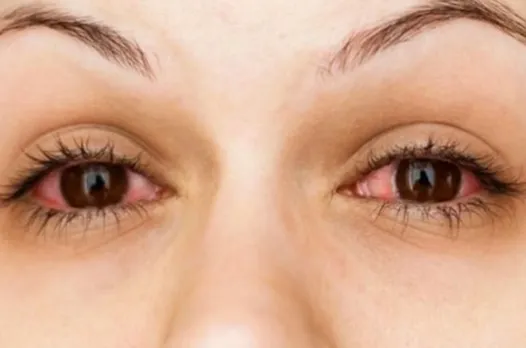 સૂર્યના તીવ્ર કિરણોને કારણે આંખની સમસ્યા થાય છે. આ કિરણો અલ્ટ્રાવાયોલેટના રૂપમાં હોય 