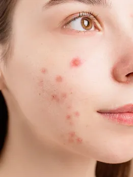 skin care tips winter applying ice on your face help to reduce acne beauty tips gujarati news