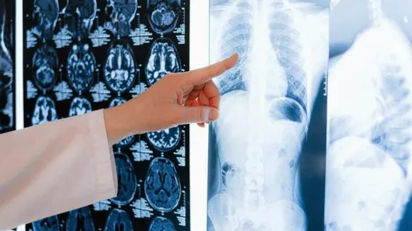 Lung cancer (Photo : Pexels)