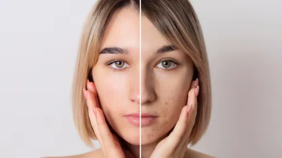 Freckles on Face Home remedies