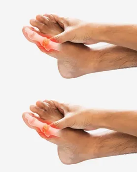 Uric acid Health tips