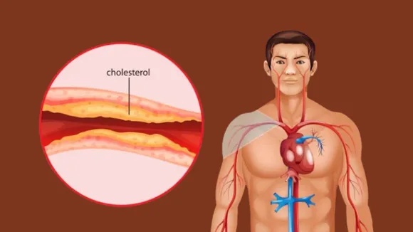 Cholesterol Levels | Cholesterol Levels Chart | HDL Cholesterol Levels | LDL Cholesterol Levels | Cholesterol