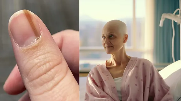 What does cancer on hand look like