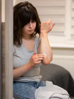 burn skin treatment home remedy, burn skin recovery