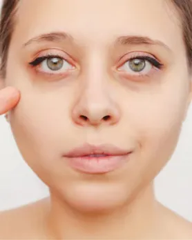 aloe vera for dark circles