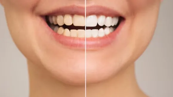 teeth whitening tips in gujarati