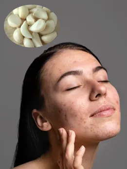 acne home remedies in gujarati