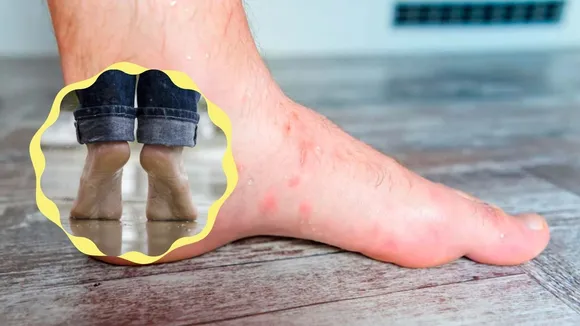 Cellulitis foot infection