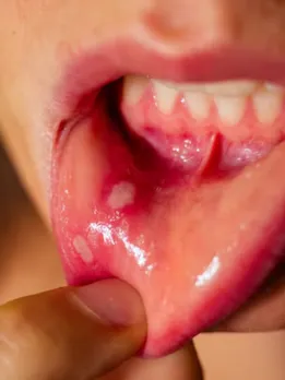 Mouth Ulcer health tips
