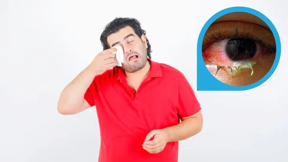 eye care tips for rainy season