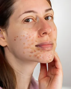 ખીલ દૂર કરવા બરફનો ઉપયોગ | ice benefits for skin acne