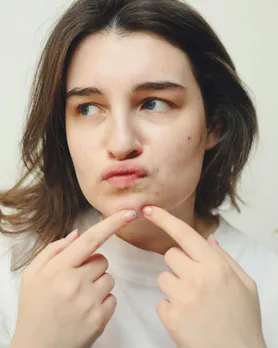 ખીલ દૂર કરવા બરફનો ઉપયોગ | ice benefits for skin acne