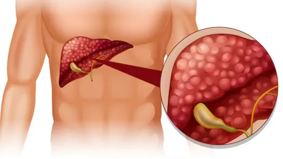 ફેટી લીવર ઘટાડવા માટે ડાયટ ટિપ્સ