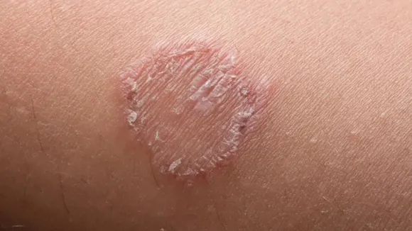 Best medicine for ringworm