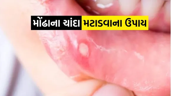 mouth ulcer | mouth ulcer tips | mo na chanda na upay | mukh ke chhallo ka upay