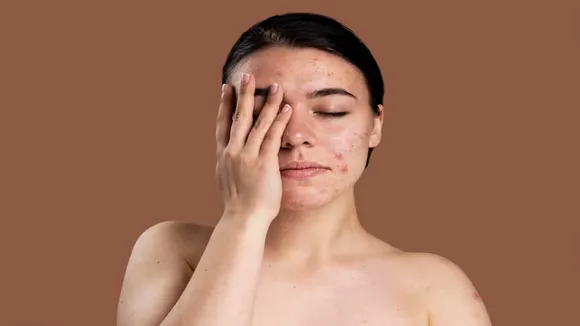 Face Care For Acne