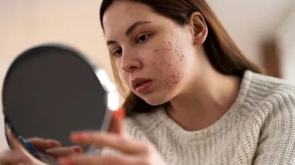 Acne, Face, Skin, Lifestyle 