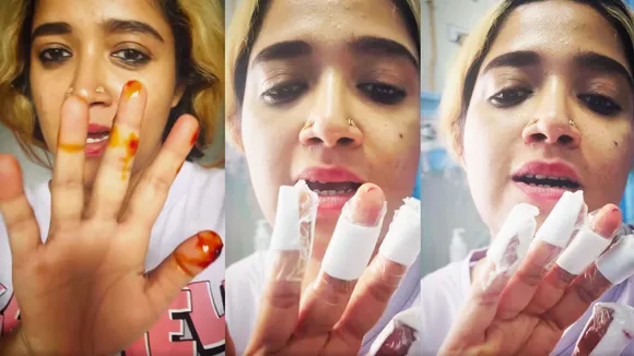  Hand Accident | Abhirami 