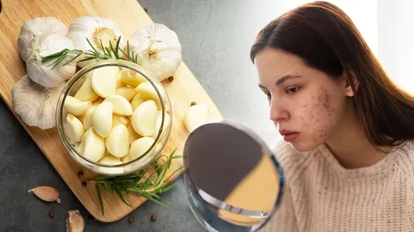 REMOVE PIMPLES 