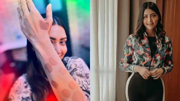 Mamtha Mohandas vitiligo Day.