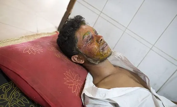 പ്രണയം നിരസിച്ച യുവാവിന്റെ മുഖത്ത് പെൺകുട്ടി ആസിഡ് ഒഴിച്ചു