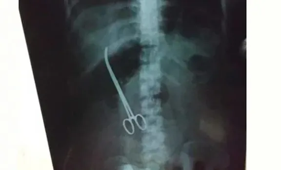 യുവതിയുടെ വയറ്റില്‍ ഡോക്ടര്‍മാര്‍ കത്രിക വെച്ച് മറന്നു; പുറത്തെടുത്തത് മൂന്ന് മാസം കഴിഞ്ഞ്