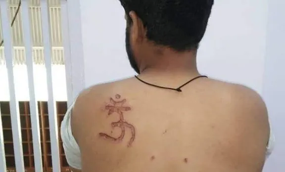 തിഹാര്‍ ജയിലിലെ മുസ്‌ലിം തടവുകാരന്റെ ശരീരത്തില്‍ ജയില്‍ അധികൃതര്‍ 'ഓം' ചാപ്പകുത്തി